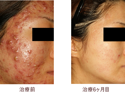 治療前 治療6ヶ月後