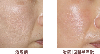治療前 治療1回目半年後