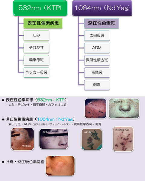 「スペクトラ」は安全性、効果とも非常に高いレーザーです