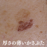 しみ治療について